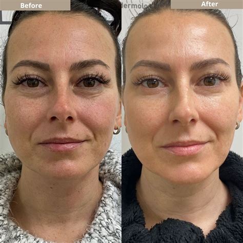 endermologie reviews|endermologie before and after.